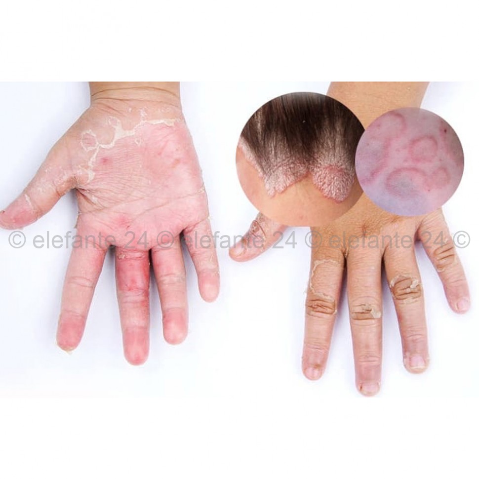 Антибактериальный крем от кожных заболеваний 15g (106)